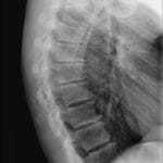Lateral thoracic spine X-ray showing Scheuermann's disease with vertebral wedging and Schmorl's nodes.