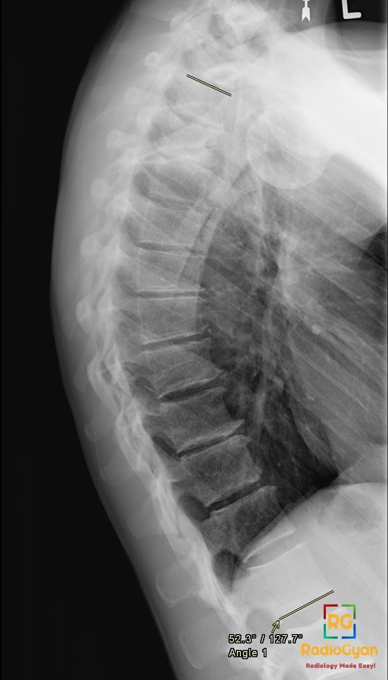 Lateral thoracic spine X-ray showing Scheuermann's disease with vertebral wedging and Schmorl's nodes.