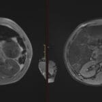 MRI comparing in-phase and out-of-phase abdominal images showing secondary hemosiderosis in a sickle cell patient.