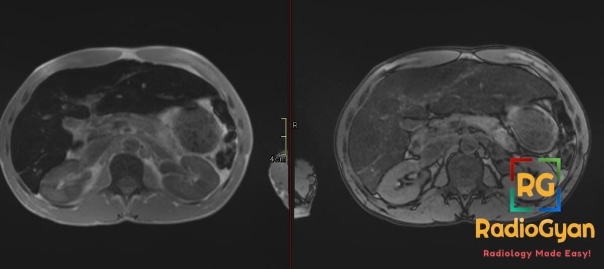 MRI comparing in-phase and out-of-phase abdominal images showing secondary hemosiderosis in a sickle cell patient.