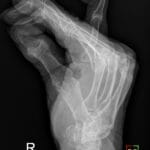 X-ray of the right hand showing swan-neck deformity of the fifth digit and palmar subluxation at the MCP joint.