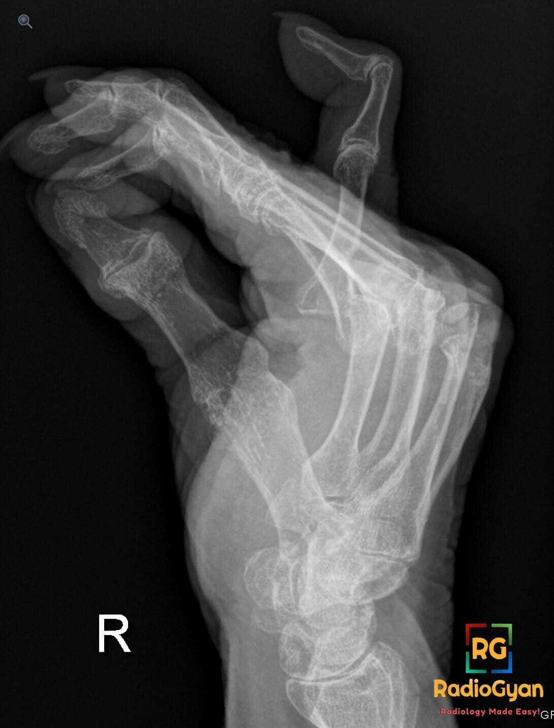 X-ray of the right hand showing swan-neck deformity of the fifth digit and palmar subluxation at the MCP joint.