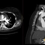 CT angiogram axial and sagittal views showing a Stanford Type A aortic dissection involving the ascending aorta.