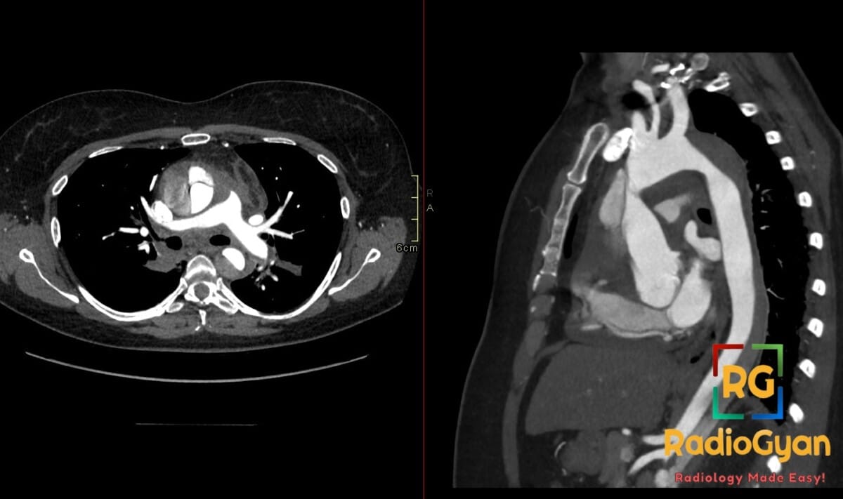 CT angiogram axial and sagittal views showing a Stanford Type A aortic dissection involving the ascending aorta.