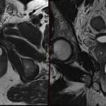 MRI scan of the pelvis showing a urethral diverticulum, a sac-like protrusion from the urethra.