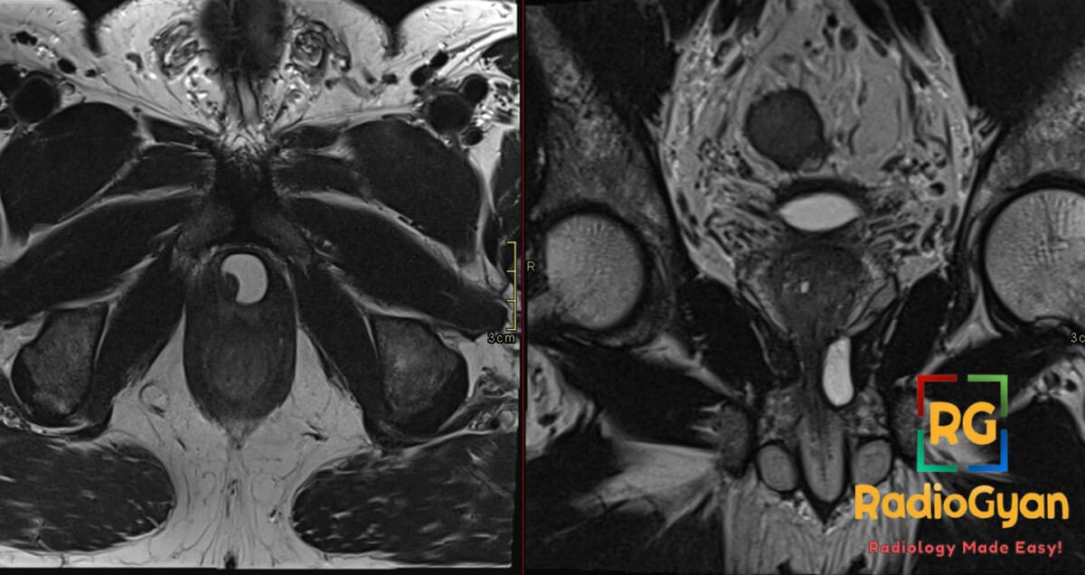 MRI scan of the pelvis showing a urethral diverticulum, a sac-like protrusion from the urethra.