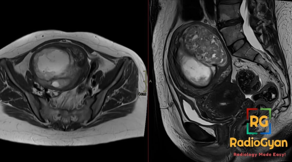 Axial and sagittal MRI of the pelvis showing a large, heterogeneous uterine mass, suggestive of leiomyosarcoma.