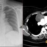 Chest X-ray and CT scan showing a large anterior mediastinal mass with hilum overlay sign, consistent with mature cystic teratoma.