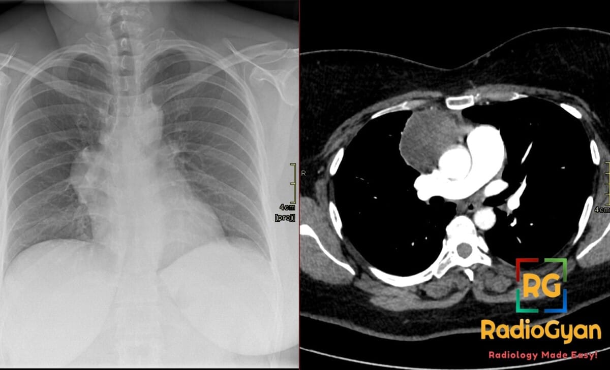 Chest X-ray and CT scan showing a large anterior mediastinal mass with hilum overlay sign, consistent with mature cystic teratoma.