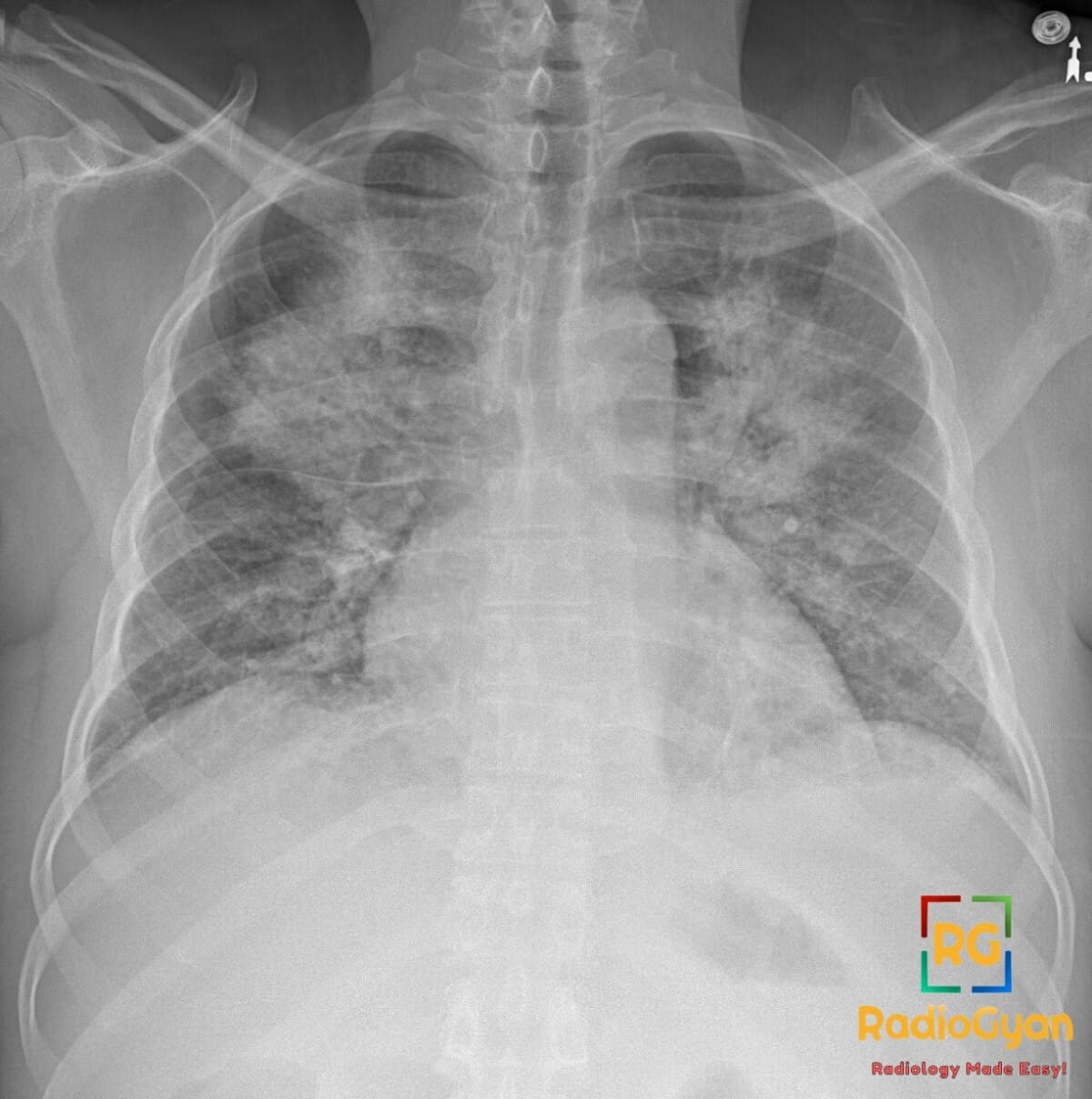 Chest X-ray showing diffuse bilateral pulmonary opacities characteristic of a batwing appearance from pulmonary edema.