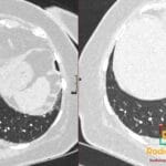 CT thorax showing diffuse pulmonary meningotheliomatosis with the Cheerio sign.