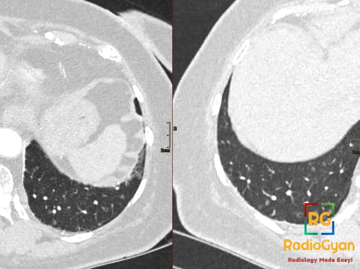 CT thorax showing diffuse pulmonary meningotheliomatosis with the Cheerio sign.