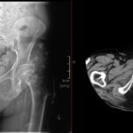 X-ray and CT scans showing diffuse subcutaneous calcifications and calcinosis cutis universalis due to ESRD.