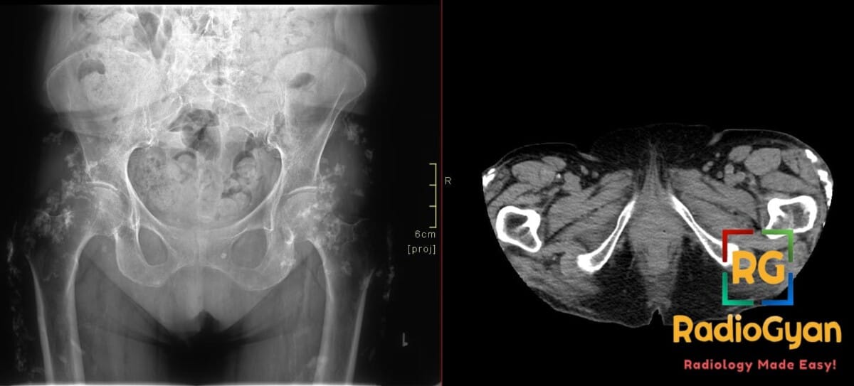 X-ray and CT scans showing diffuse subcutaneous calcifications and calcinosis cutis universalis due to ESRD.