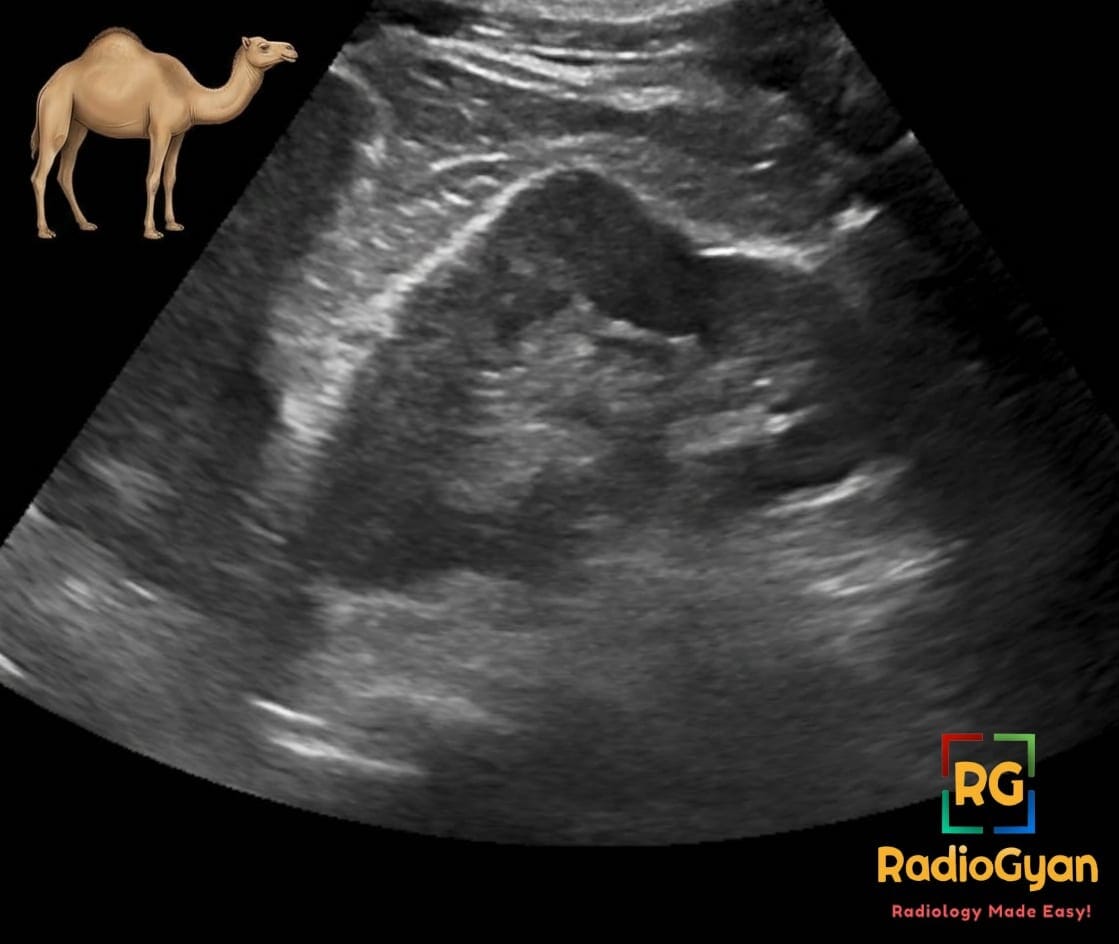 Ultrasound image of a left kidney showing a dromedary hump, a normal kidney variant, with a camel icon for illustration.
