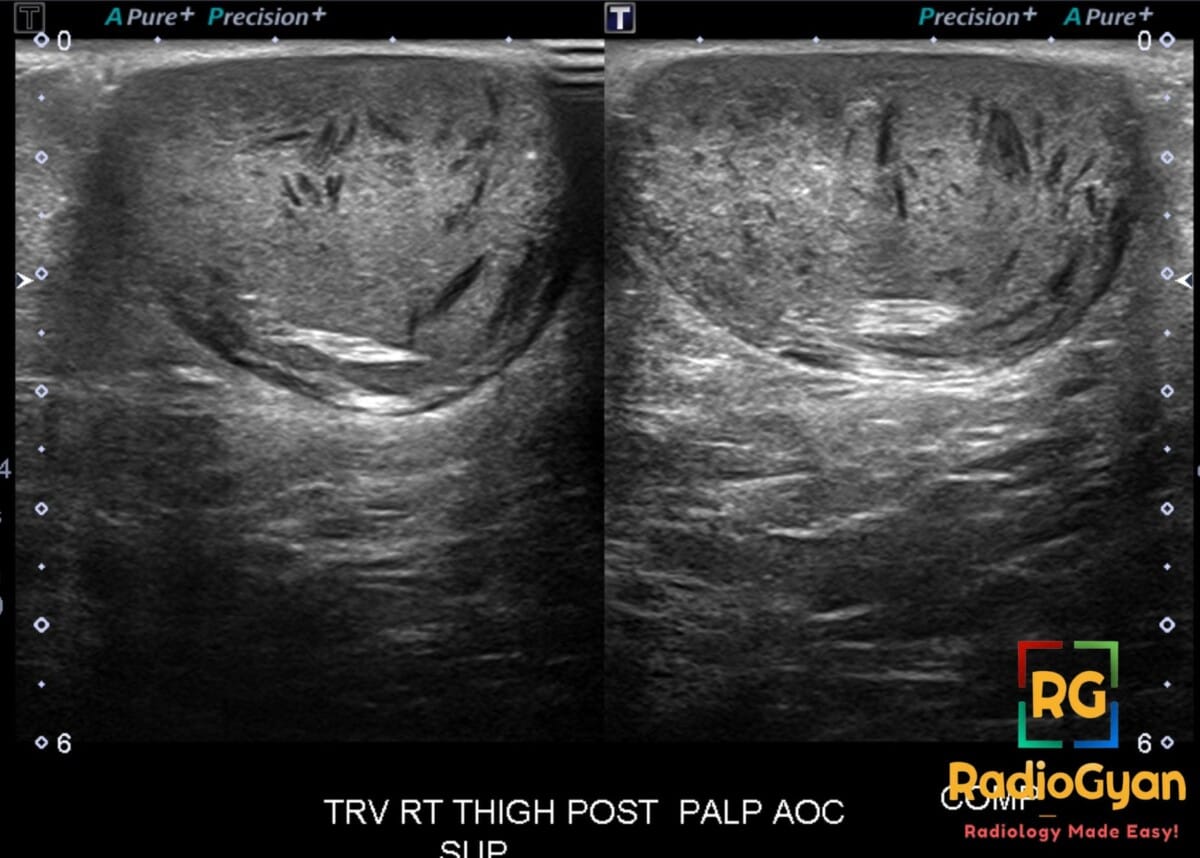 Ultrasound of epidermal inclusion cyst with heterogeneous echotexture and internal anechoic filiform areas.