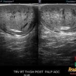 Ultrasound image of a right thigh showing an epidermal inclusion cyst with filiform anechoic areas.