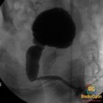 Fluoroscopic image of an infant's urethra during VCUG voiding phase, showing marked posterior urethral dilation.