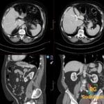 CT scan showing isolated gastric fundal varices due to splenic vein thrombosis with prominent draining vein into the left portal vein.