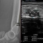 X-ray and Ultrasound showing low-flow vascular malformation with phleboliths in the forearm's anterior subcutaneous tissues.