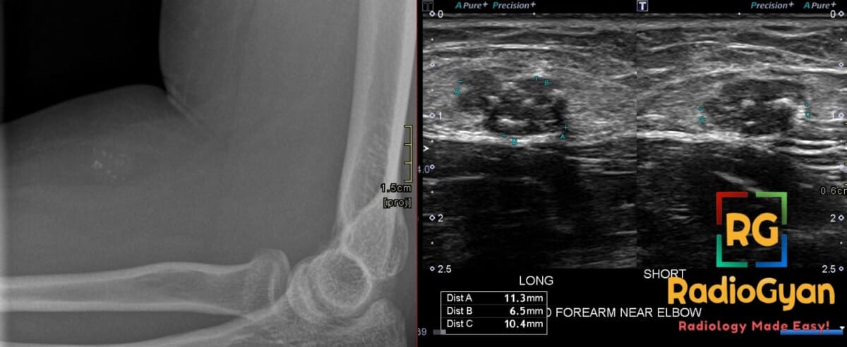 X-ray and Ultrasound showing low-flow vascular malformation with phleboliths in the forearm's anterior subcutaneous tissues.