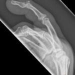 Lateral X-ray of a finger showing a mallet finger deformity with distal phalanx avulsion fracture and extensor tendon injury.