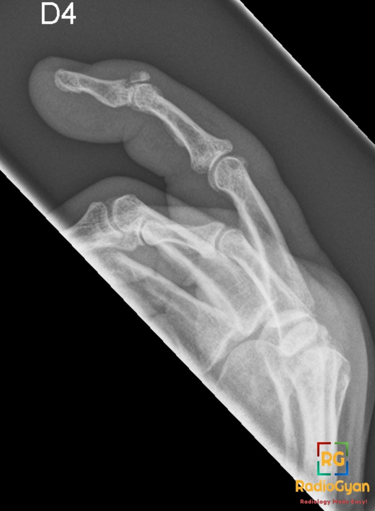 Lateral X-ray of a finger showing a mallet finger deformity with distal phalanx avulsion fracture and extensor tendon injury.