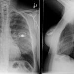 AP and lateral chest X-ray views showing normal lungs and heart, with bilateral radiopaque saline breast implant markers.