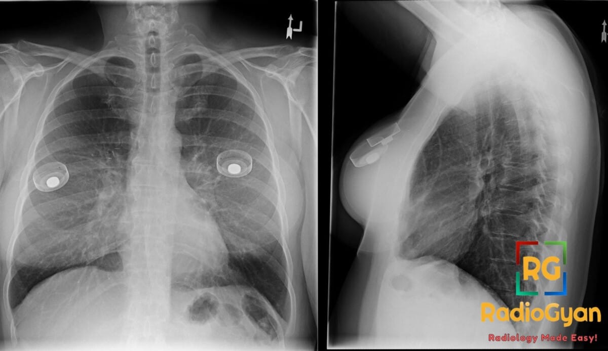 Anterior-posterior (AP) and lateral chest X-ray views showing normal saline breast implants and the chest anatomy.