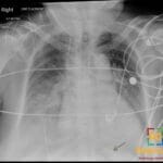 Chest X-ray showing proper placement of a right internal jugular line and a temporary pacemaker lead in the heart.