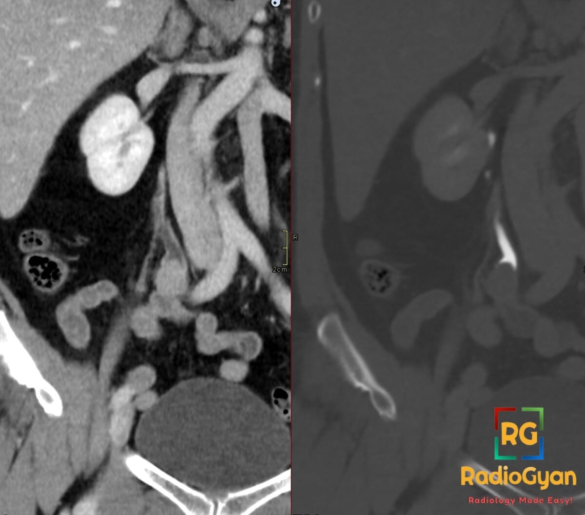 CT scan showing right upper ureteric urothelial carcinoma as a soft tissue lesion and a filling defect.