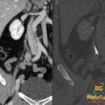 CT scan showing a soft tissue lesion in the right upper ureter on portal venous phase and a filling defect on urogram.