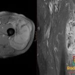 GRE MRI shows undifferentiated pleomorphic sarcoma with hemorrhage and necrosis in an elderly patient.