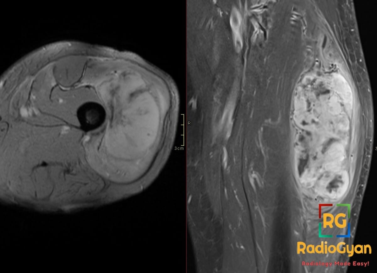GRE MRI shows undifferentiated pleomorphic sarcoma with hemorrhage and necrosis in an elderly patient.