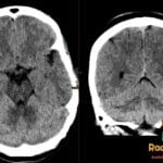 Axial and coronal CT of the brain showing difuss low attenuation of the cerebral hemisphere while the cerebellum appears hyperdense.