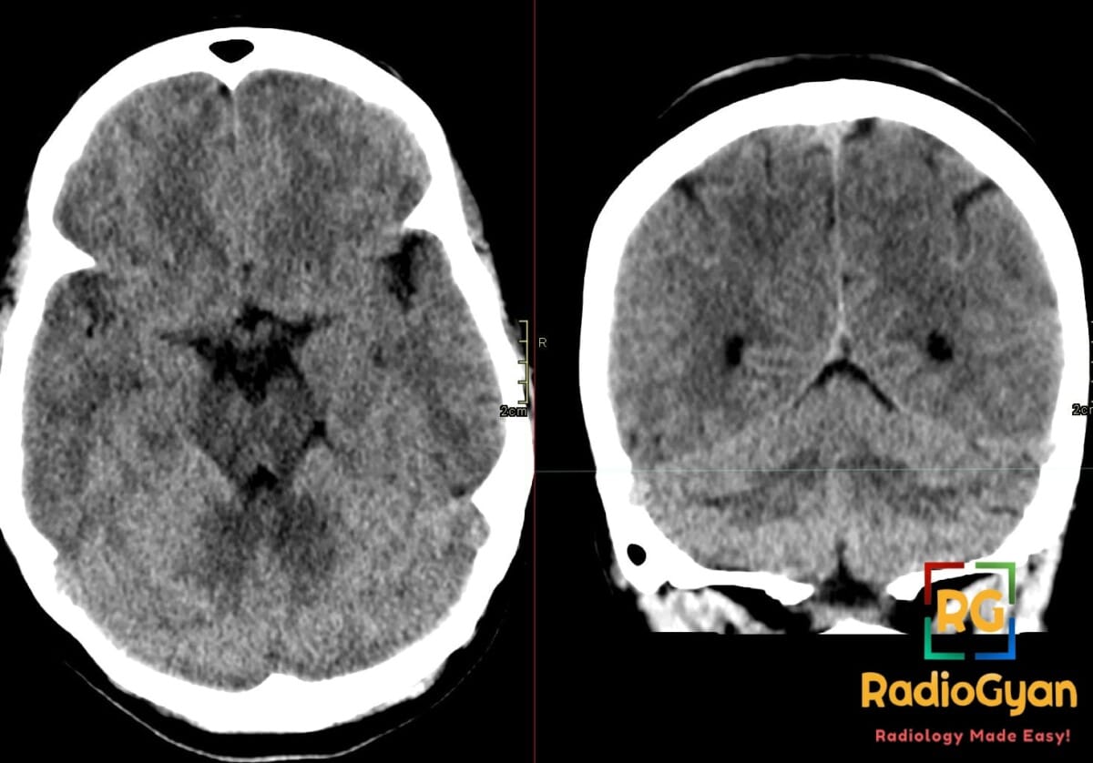 Axial and coronal CT of the brain showing difuss low attenuation of the cerebral hemisphere while the cerebellum appears hyperdense.