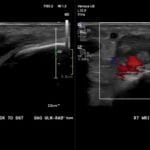 Ultrasound image showing acute non-exudative tenosynovitis of the wrist extensor tendon with grayscale and color Doppler.