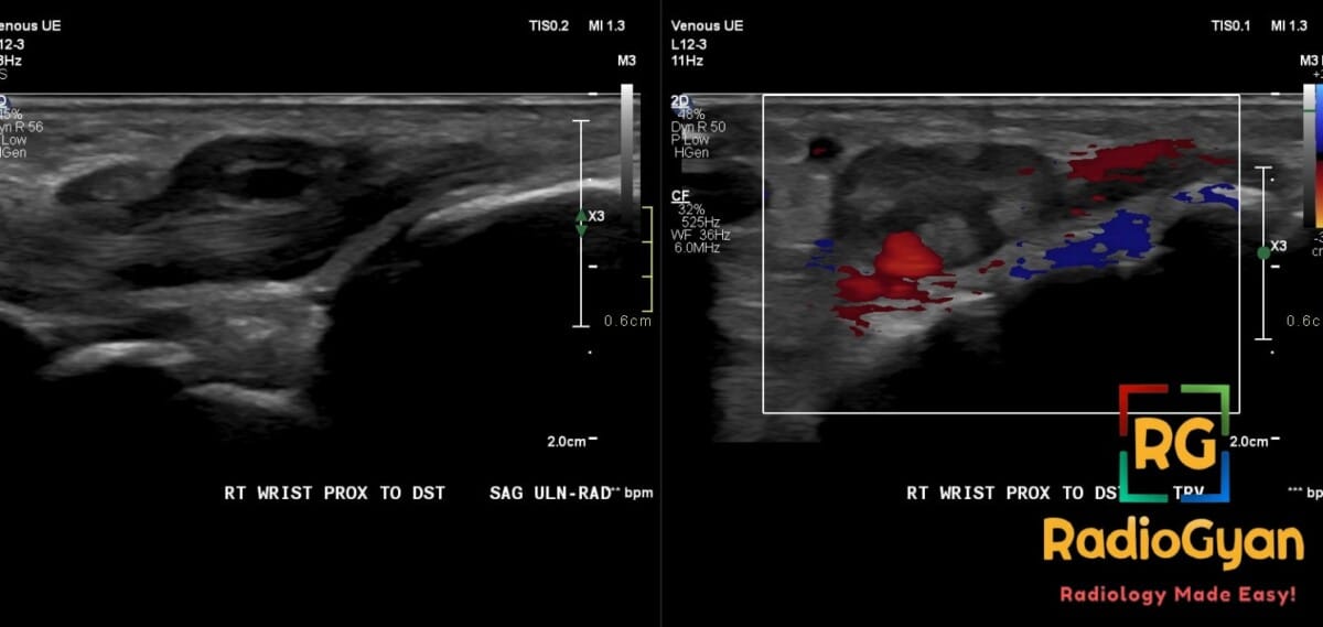 Ultrasound image showing acute non-exudative tenosynovitis of the wrist extensor tendon with grayscale and color Doppler.