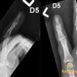 X-ray of the fifth digit showing an acute volar plate avulsion fracture with slight medial dislocation at the PIP joint.