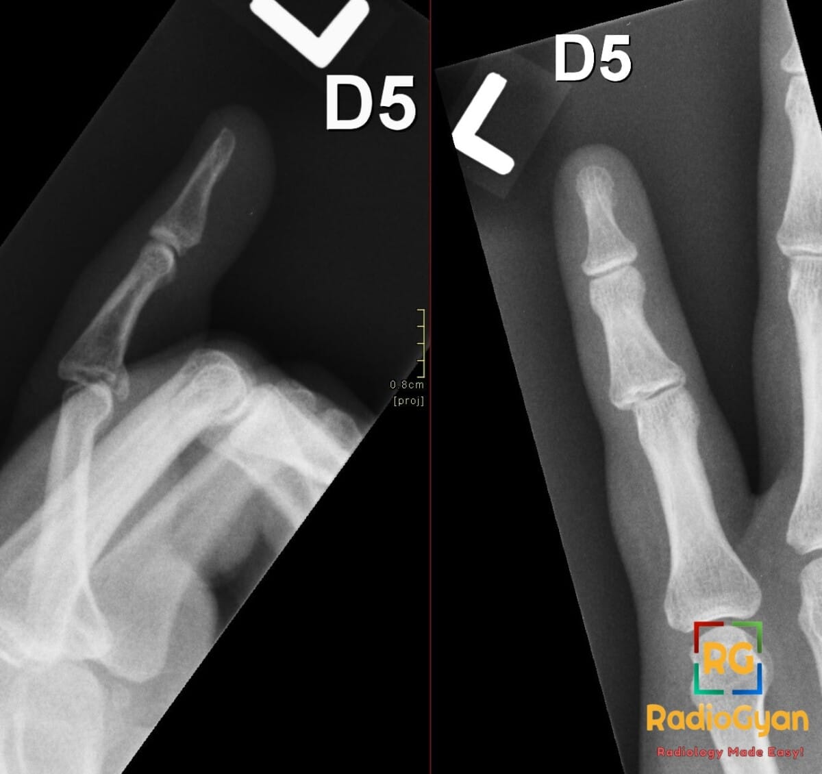 X-ray of the fifth digit showing an acute volar plate avulsion fracture with slight medial dislocation at the PIP joint.