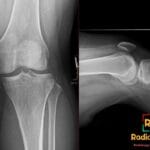 Anteroposterior and lateral knee X-rays showing an arcuate sign, an avulsion fracture of the proximal fibula head.