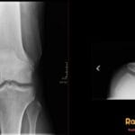 AP and skyline X-rays of a knee showing a bipartite patella, an incidental finding considered a normal variant.