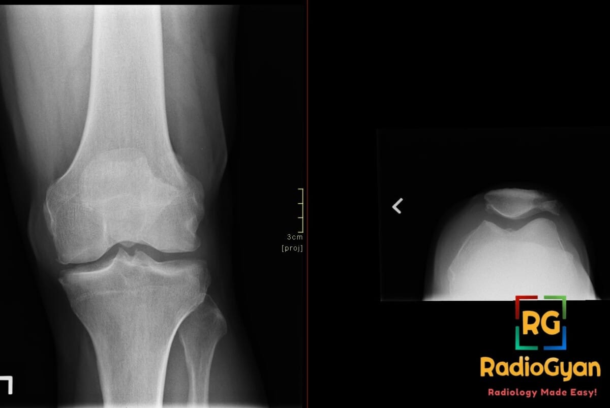 AP and axial knee X-rays showing bipartite patella, an incidental finding and normal variant, with clear separation of bone.