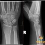 AP and lateral wrist X-rays showing a capitohamate coalition, an incidental carpal fusion.