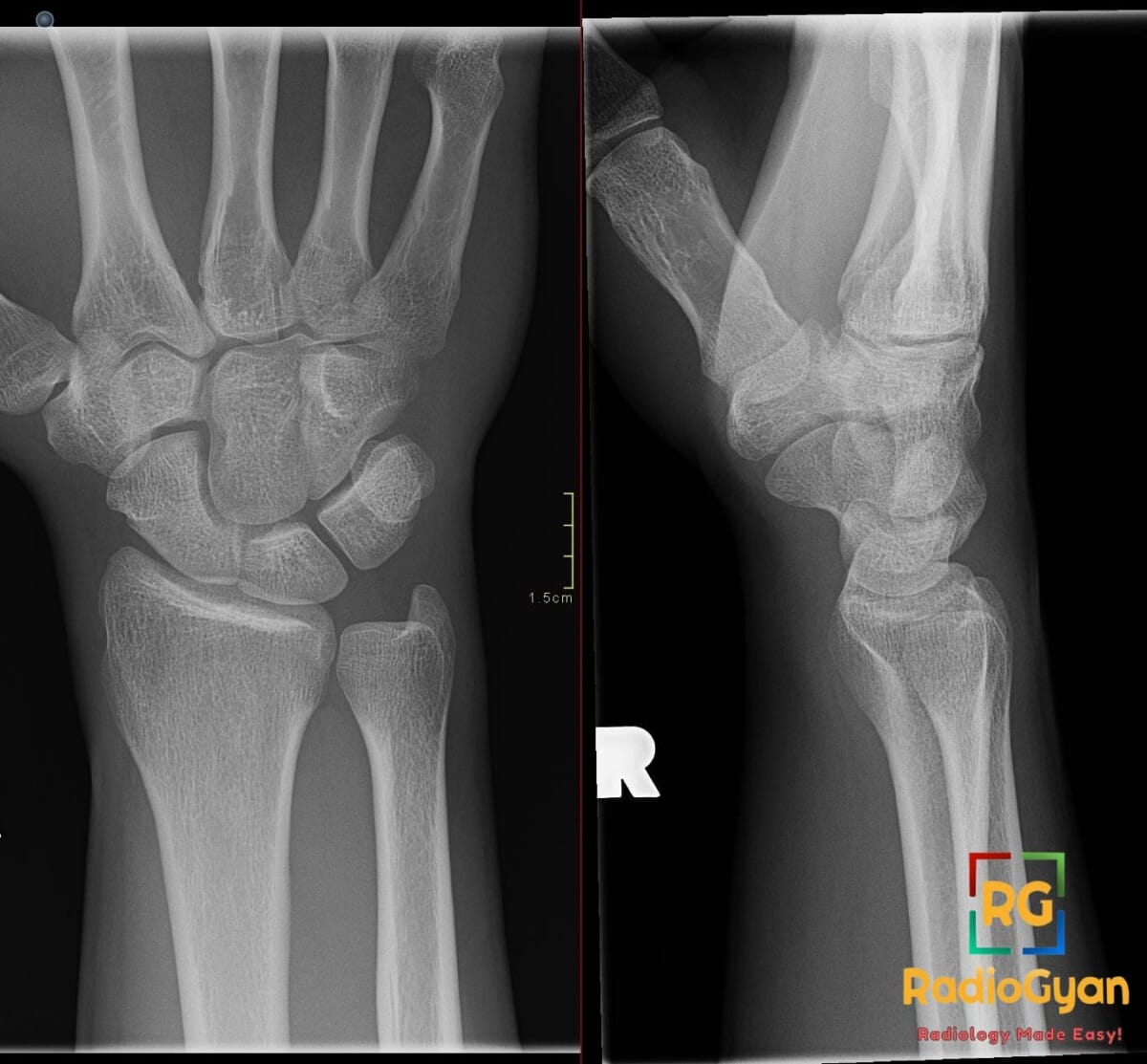 AP and lateral wrist X-rays showing a capitohamate coalition, an incidental carpal fusion.