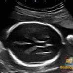 Fetal ultrasound showing Cavum Vergae, a normal variant within the developing fetal brain.