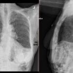 Chest X-ray showing Chilaiditi sign, incidental finding of bowel gas between liver and diaphragm.