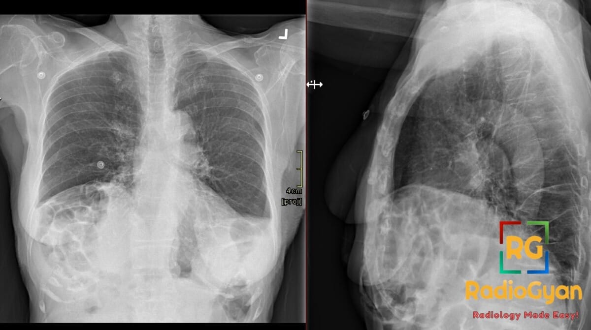 Chest X-ray showing Chilaiditi sign, incidental finding of bowel gas between liver and diaphragm.