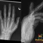 AP and oblique X-ray of the hand showing a dislocation at the fifth digit PIP joint (Coach's Finger).
