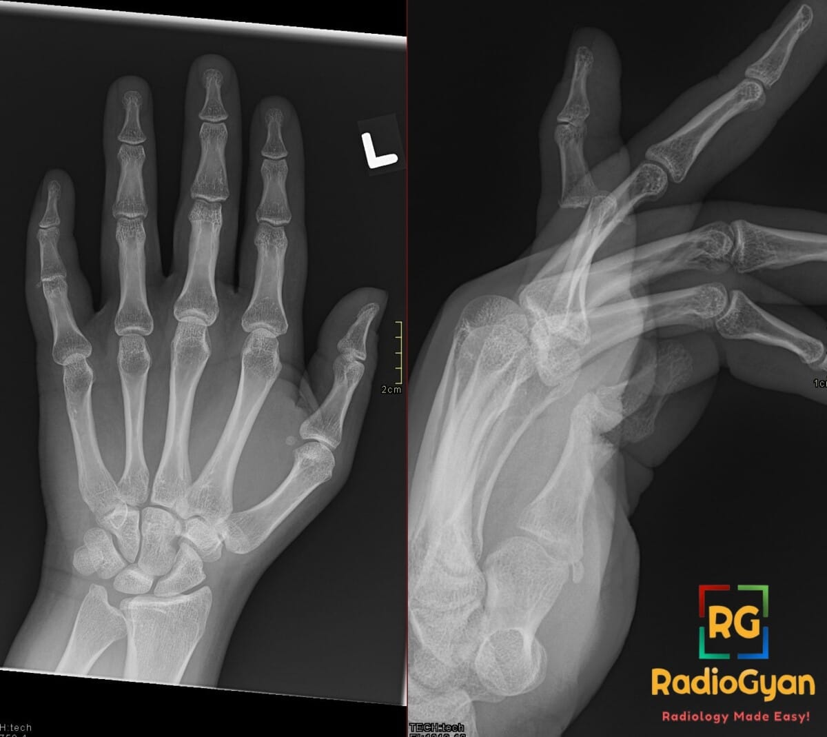 AP and oblique X-ray of the hand showing a dislocation at the fifth digit PIP joint (Coach's Finger).
